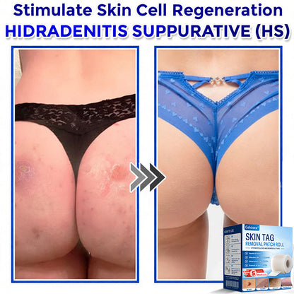 💧☘️Celsiora® Multi-Functional Microneedle Hydrocolloid Patch Roll | Targets Skin Tags, Warts & Stubborn Blemishes