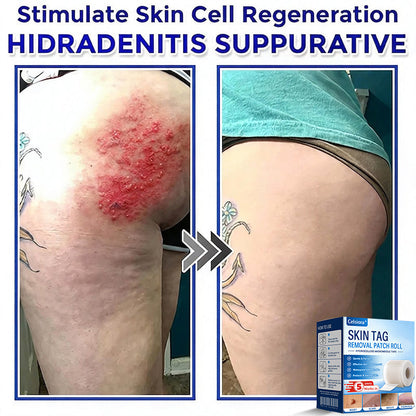 💧☘️Celsiora® Multi-Functional Microneedle Hydrocolloid Patch Roll | Targets Skin Tags, Warts & Stubborn Blemishes