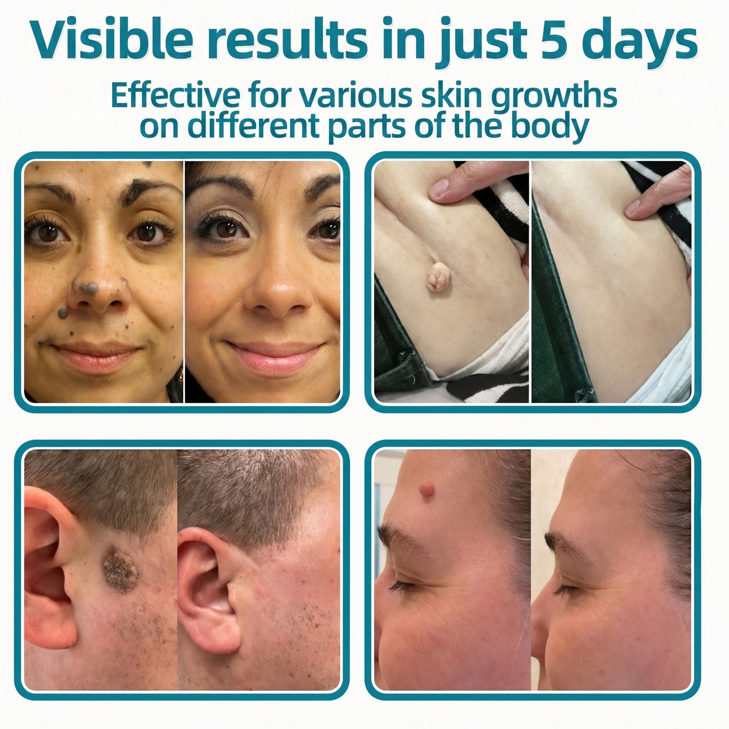 ✅🇦🇺Trilumia®2-in-1 Microneedle & Hydrocolloid Patch💫| Removes Raised Moles, Acne, Flat Warts & Skin Tags | Helps Improve Wrinkles, Scars & Blemishes | Invisible Patches for Face & Body