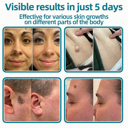 ✅🇦🇺Trilumia®2-in-1 Microneedle & Hydrocolloid Patch💫| Removes Raised Moles, Acne, Flat Warts & Skin Tags | Helps Improve Wrinkles, Scars & Blemishes | Invisible Patches for Face & Body