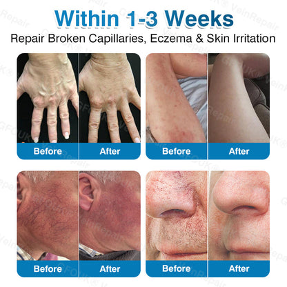 🇺🇸🏅🛡️GFOUK® VeinRepair Microneedle Patch Roll⚡Instant Relief, Long-Term Results