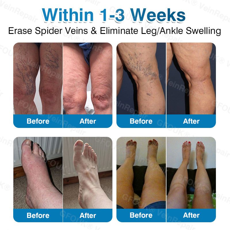 🇺🇸🏅🛡️GFOUK® VeinRepair Microneedle Patch Roll⚡Instant Relief, Long-Term Results