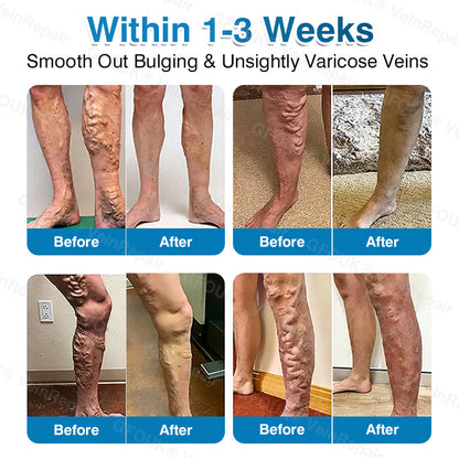 🇺🇸🏅🛡️GFOUK® VeinRepair Microneedle Patch Roll⚡Instant Relief, Long-Term Results