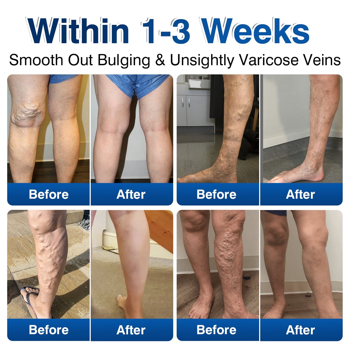 🛡️🦵GFOUK® VeinRenew Microneedle Balm