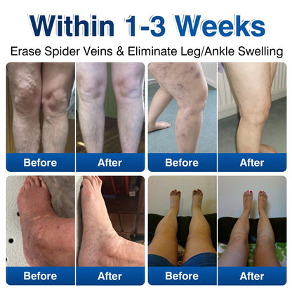 🛡️🦵GFOUK® VeinRenew Microneedle Balm
