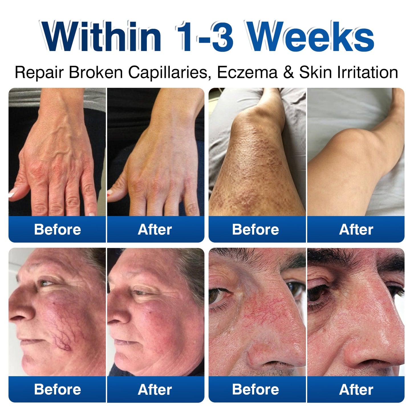 🛡️🦵GFOUK® VeinRenew Microneedle Balm