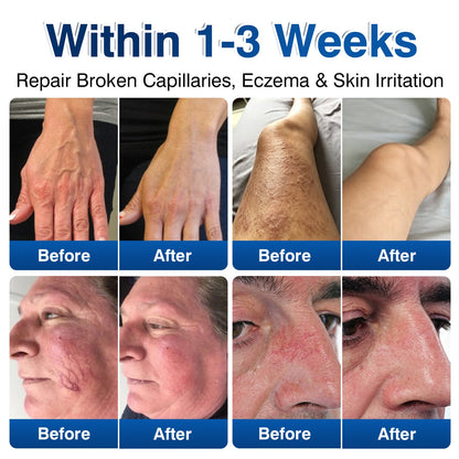 🛡️🦵GFOUK® VeinRenew Microneedle Balm
