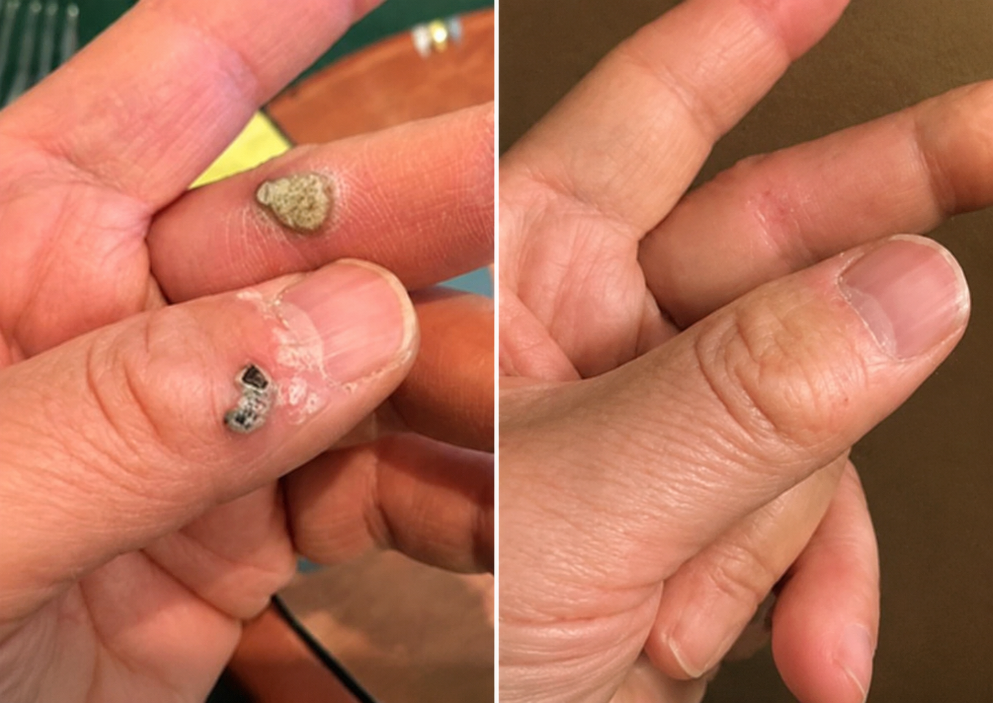 ✅🇦🇺Trilumia®2-in-1 Microneedle & Hydrocolloid Patch💫| Removes Raised Moles, Acne, Flat Warts & Skin Tags | Helps Improve Wrinkles, Scars & Blemishes | Invisible Patches for Face & Body