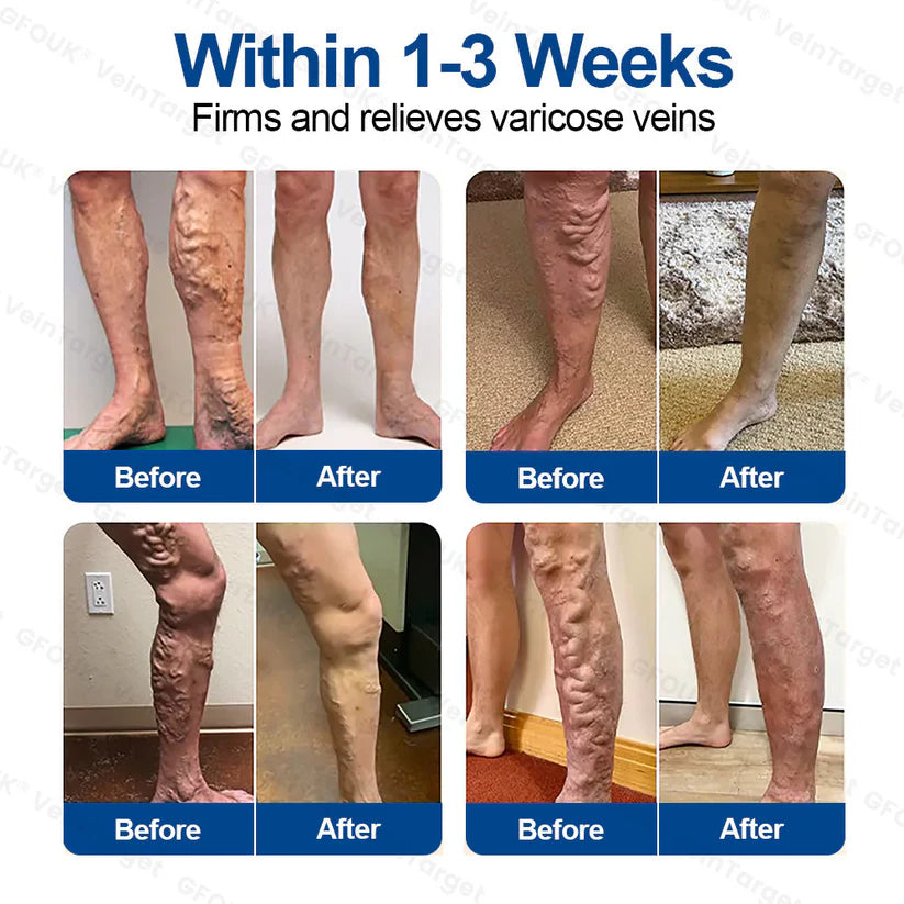 🇦🇺💧🦚GFOUK® VeinTarget Microneedle Patch⚡Instant Relief, Long-Term Results