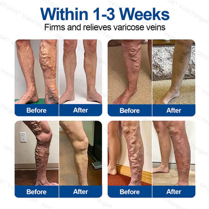 🇦🇺💧🦚GFOUK® VeinTarget Microneedle Patch⚡Instant Relief, Long-Term Results