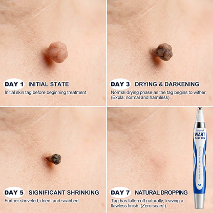 💧✨ Toclvo® Fast-Acting Wart Remover Care Pen | Targets Warts, Skin Tags & Rough Bumps