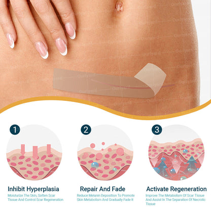 💧✅ Official Store | Ourlyard® Hyaluronic Acid Nano Microneedle Scar Repair Tape 🗽🎉 (Helps improve the appearance of surgical scars, old scars, and raised scars)