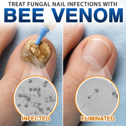 💧🔥 Celsiora® Fungal Nail Treatment | Bee Venom Formula | Gentle At-Home Nail Care